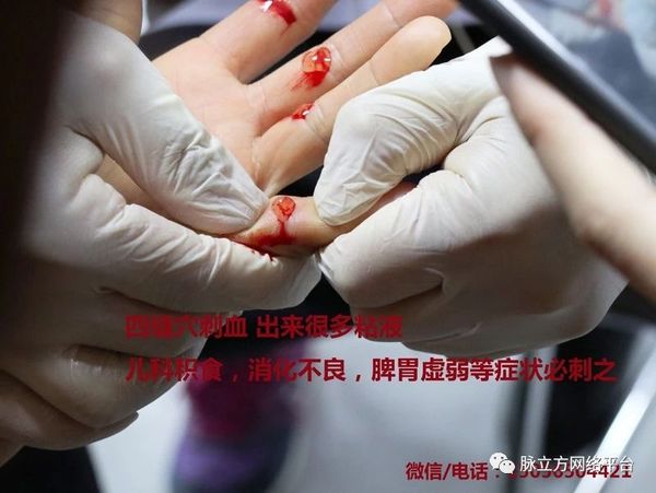 脉立方四缝穴刺血疗法技术介绍 - 脉立方刺血放血疗法